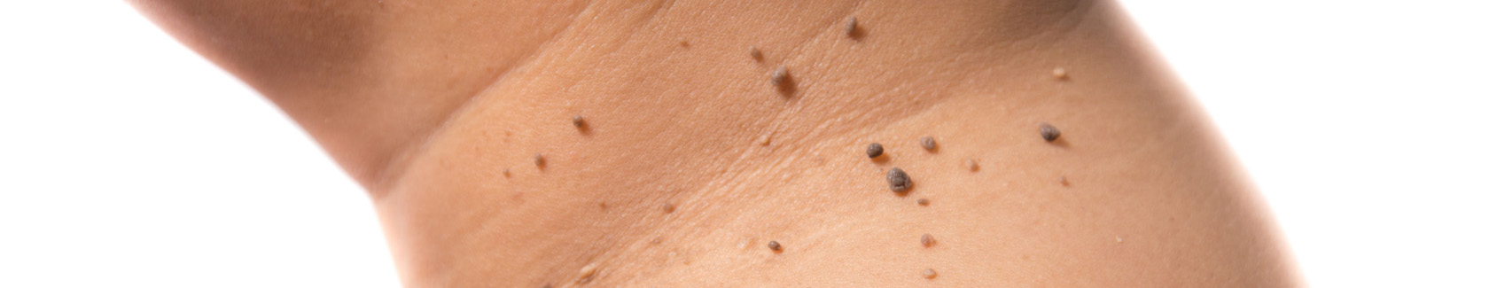 steelwratjes (fibromen) verwijderen bij huidtherapie gelderland zuid in Ochten